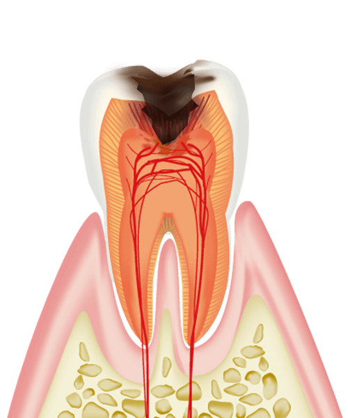 C3（象牙質の虫歯）