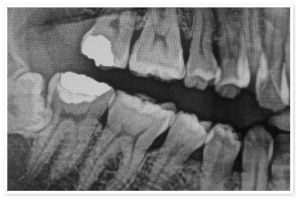 口腔外科なら本駒込 白山の歯科 歯医者 文京シティ歯科へ 親知らずの抜歯 顎関節症治療対応の本駒込 白山の歯科 歯医者