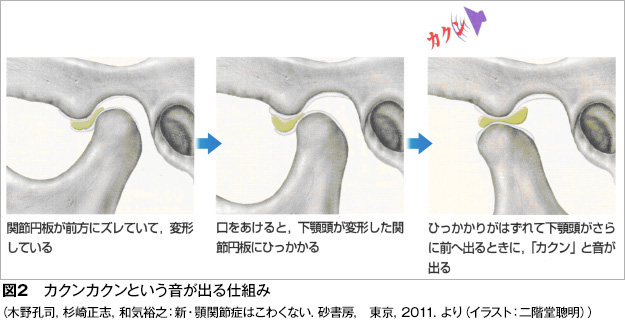 顎関節症はどんな状態になるのですか